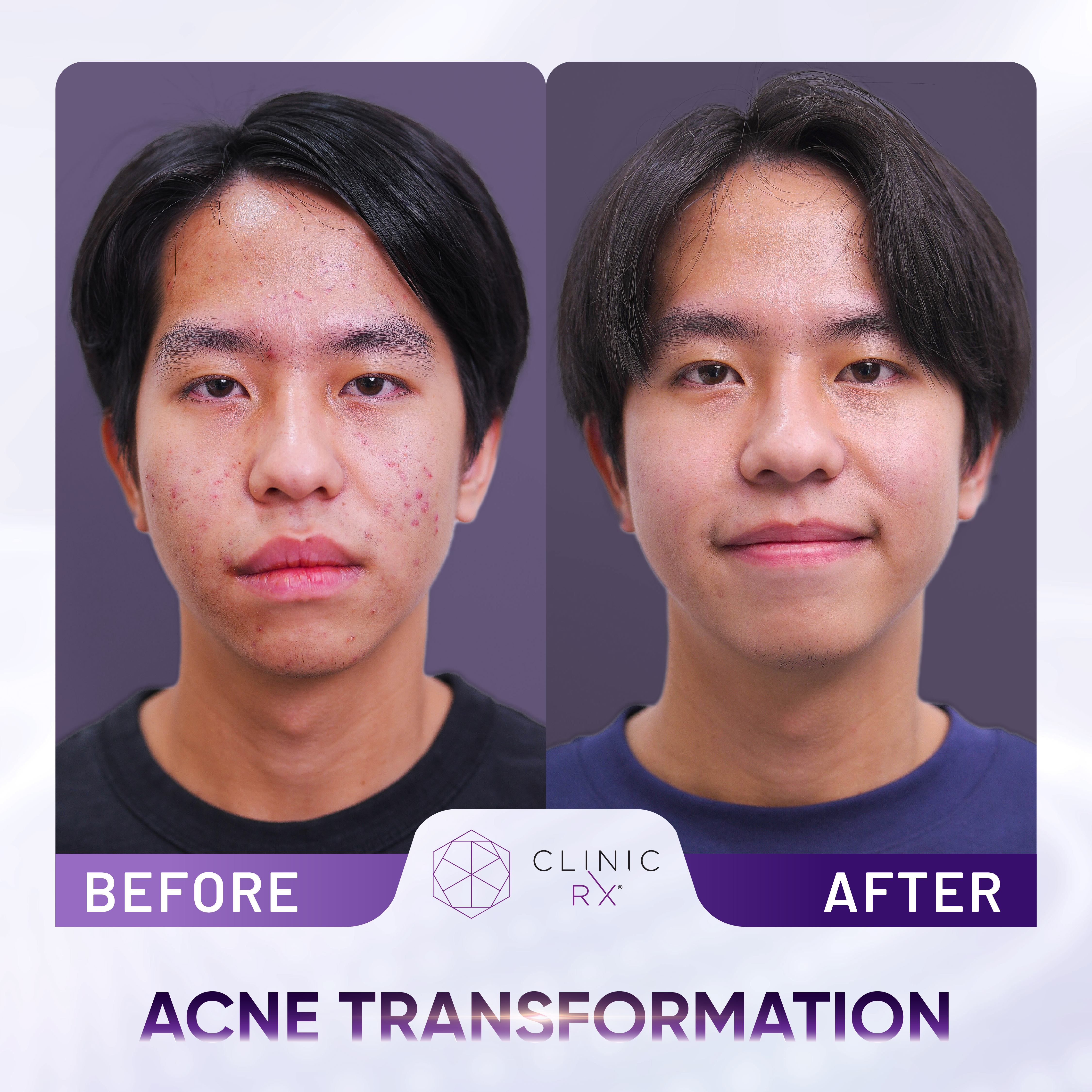 Acne result 4