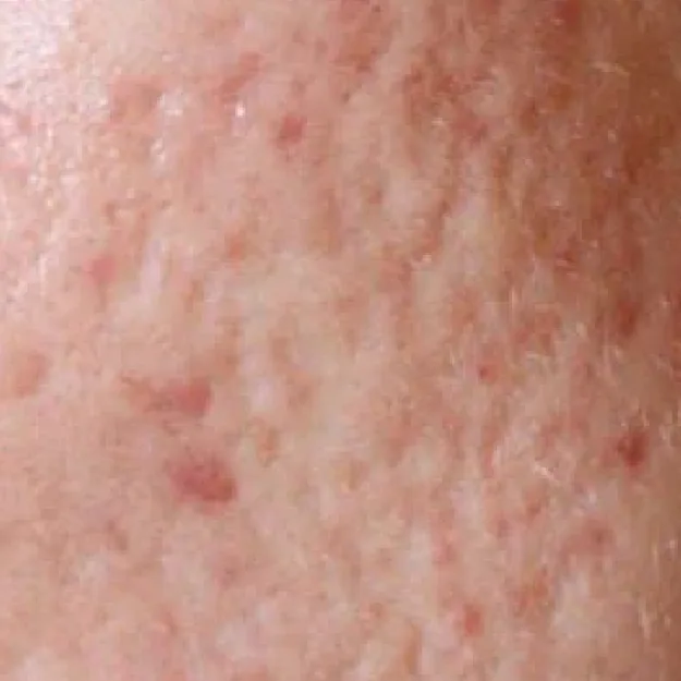 Atrophic / Indented Acne Scars
