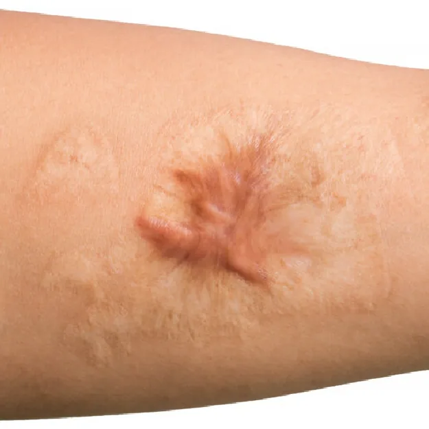 Hypertrophic & Keloid Acne Scars