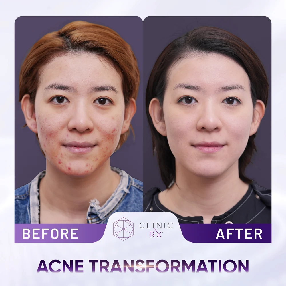 Acne result 1