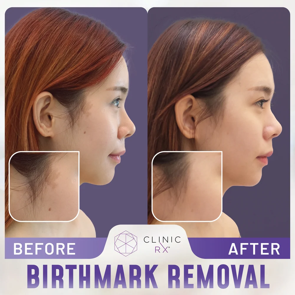 Birthmark result 1