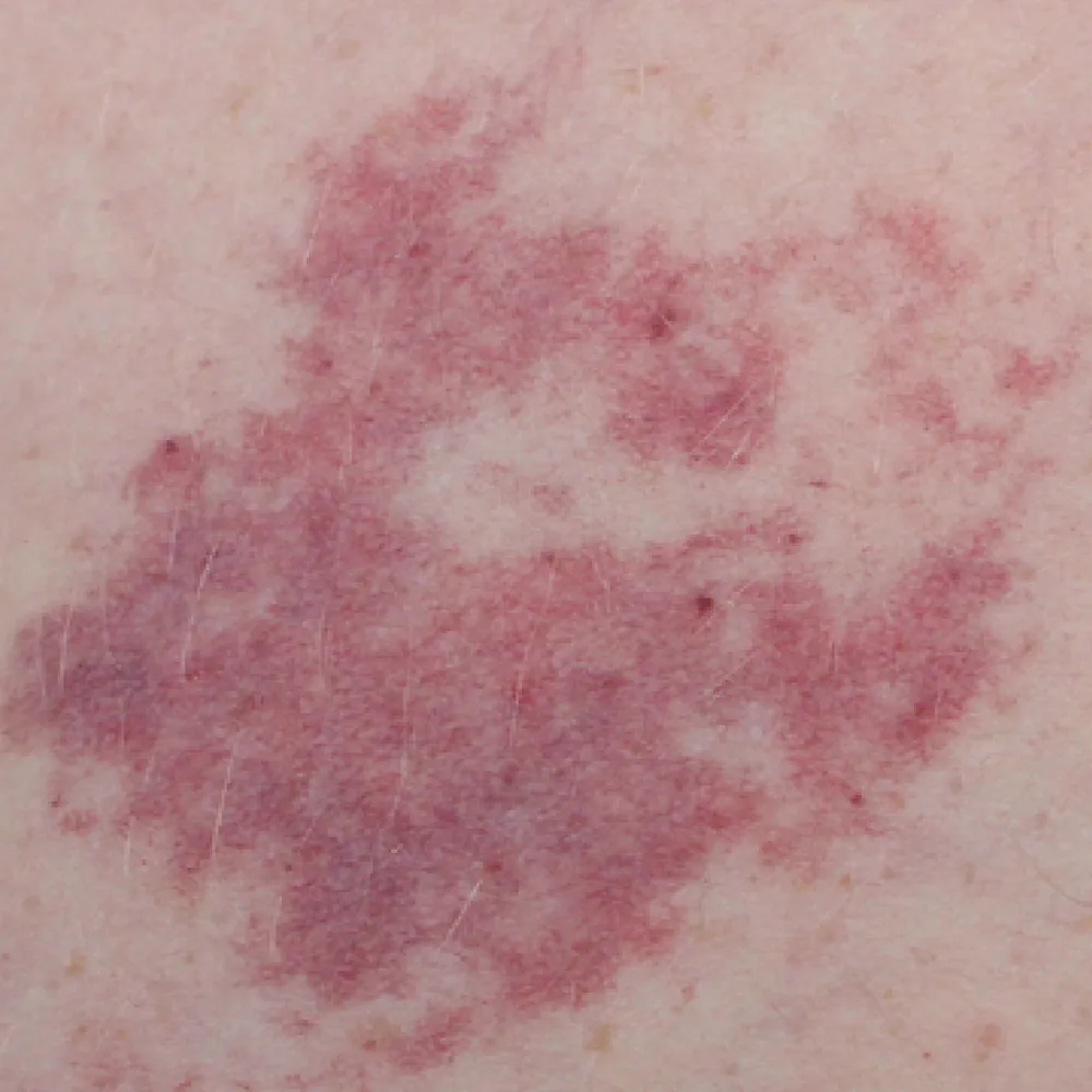 Pigmented Birthmarks