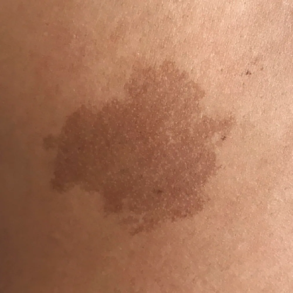 Vascular Birthmarks