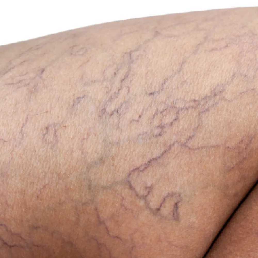 Mixed Birthmarks