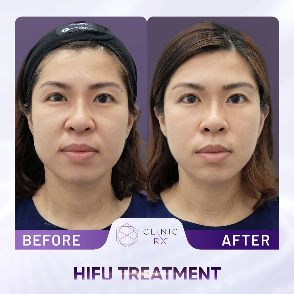 Chubby Cheeks result 1
