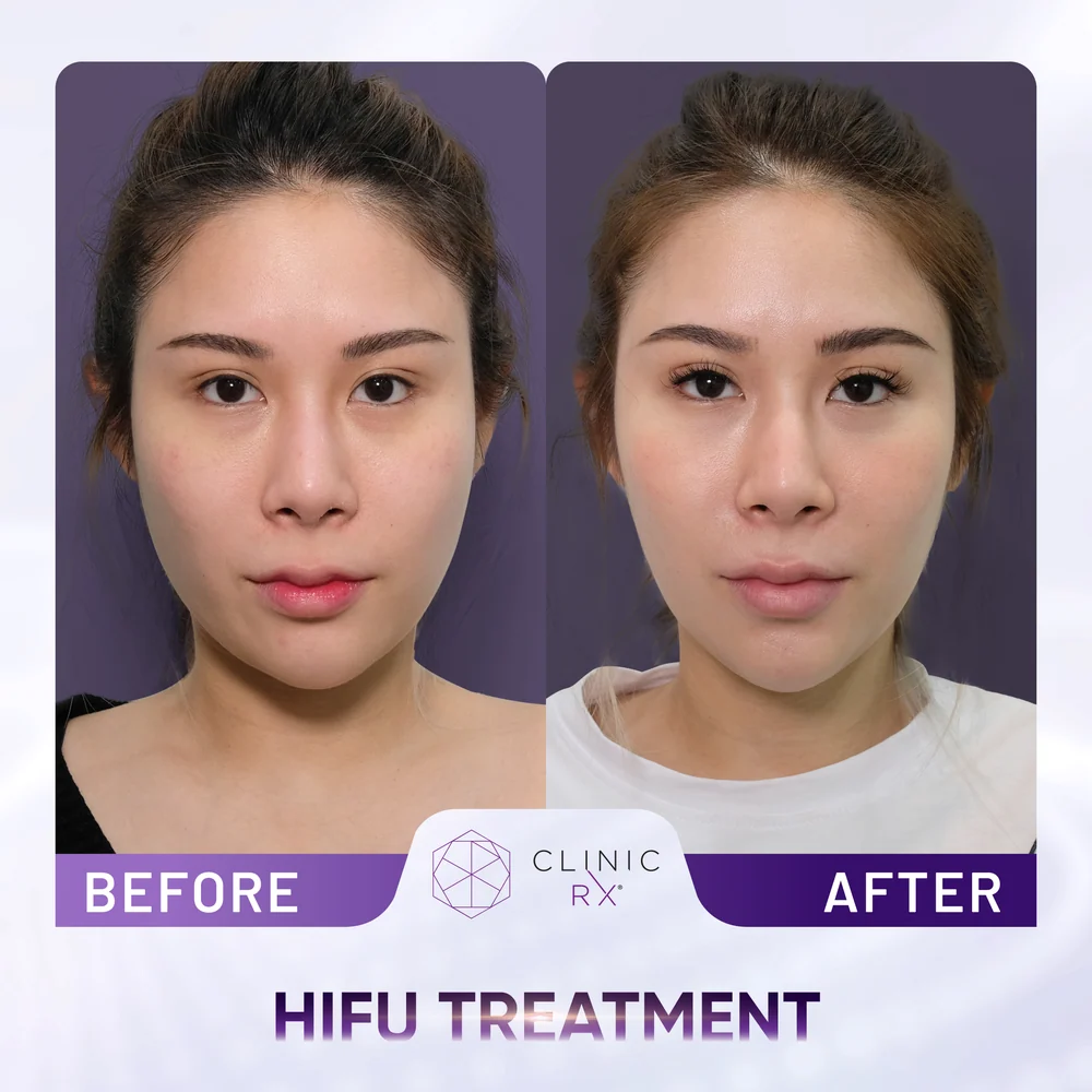 Chubby Cheeks result 2