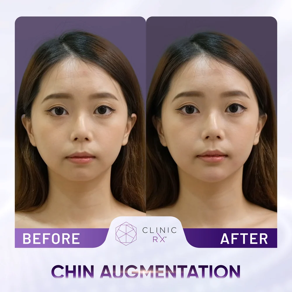 Chubby Cheeks result 3