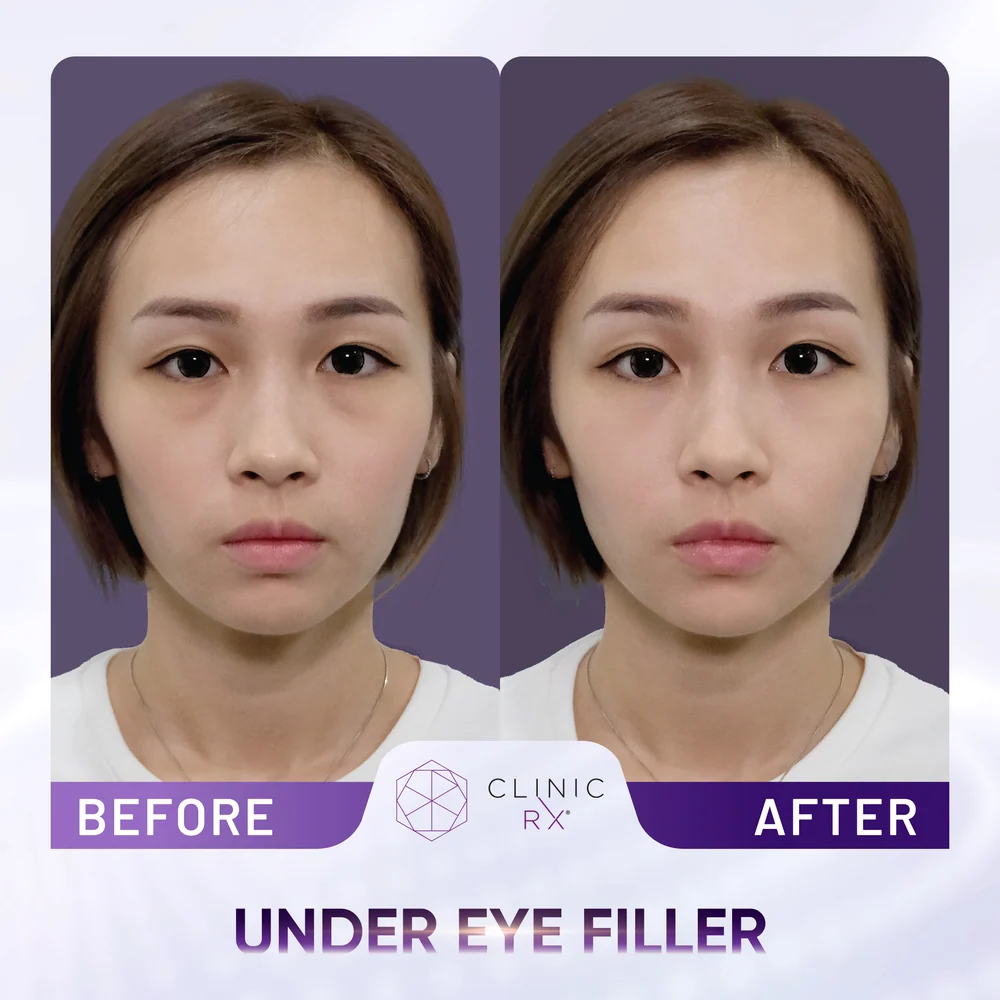 Dark Eye Circles result 1