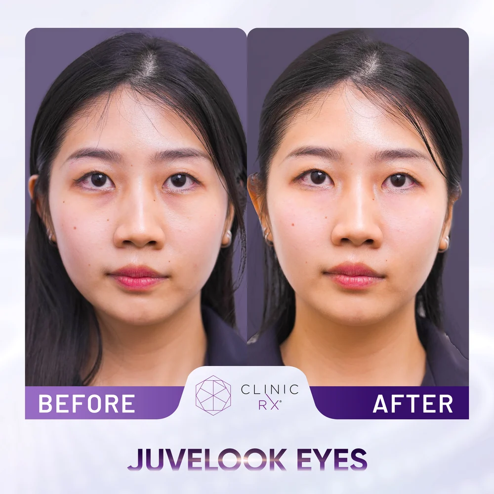 Dark Eye Circles result 2