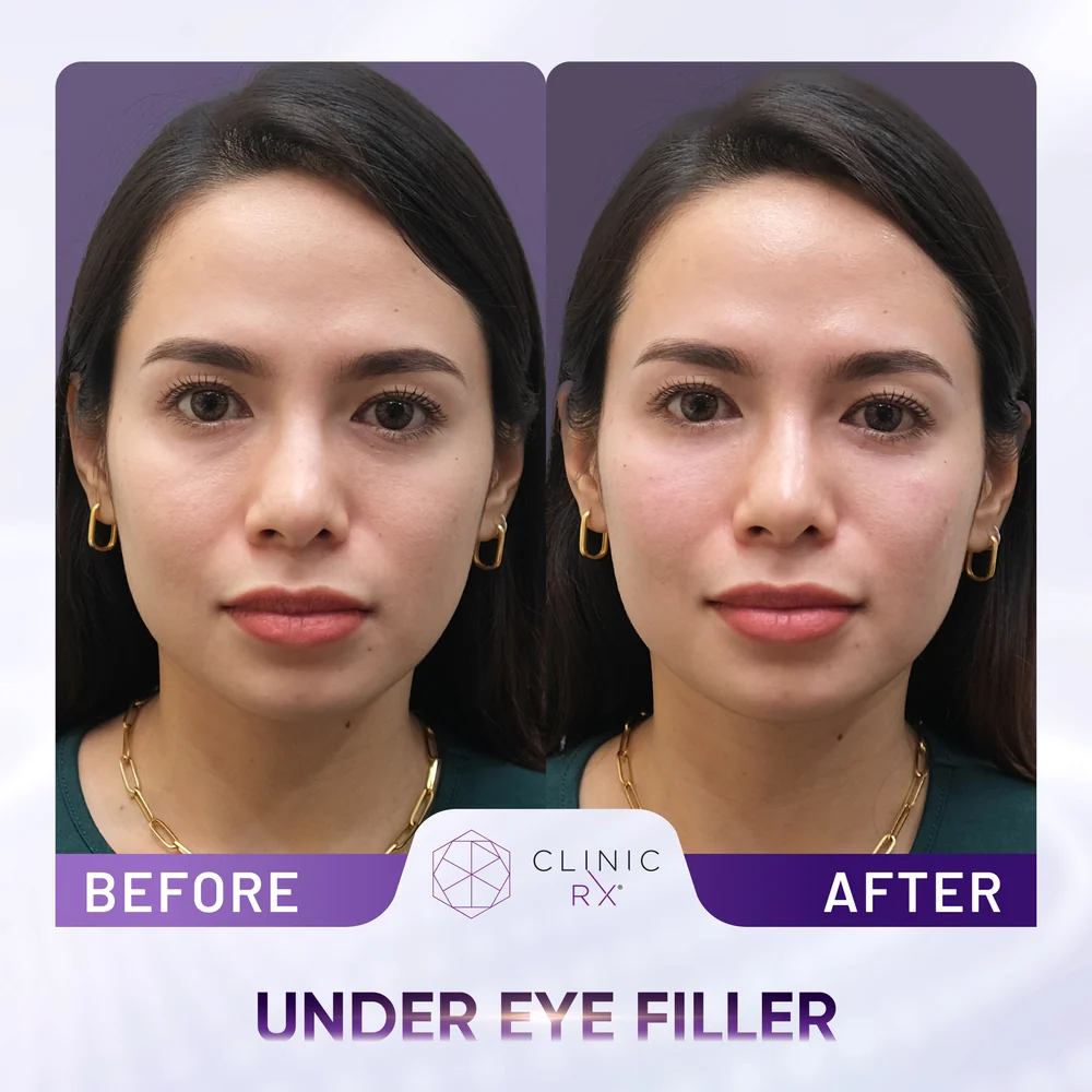 Dark Eye Circles result 3