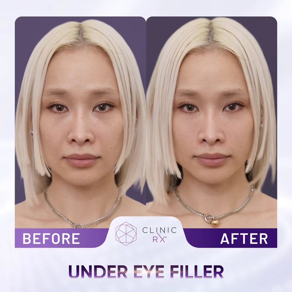 Dark Eye Circles result 4