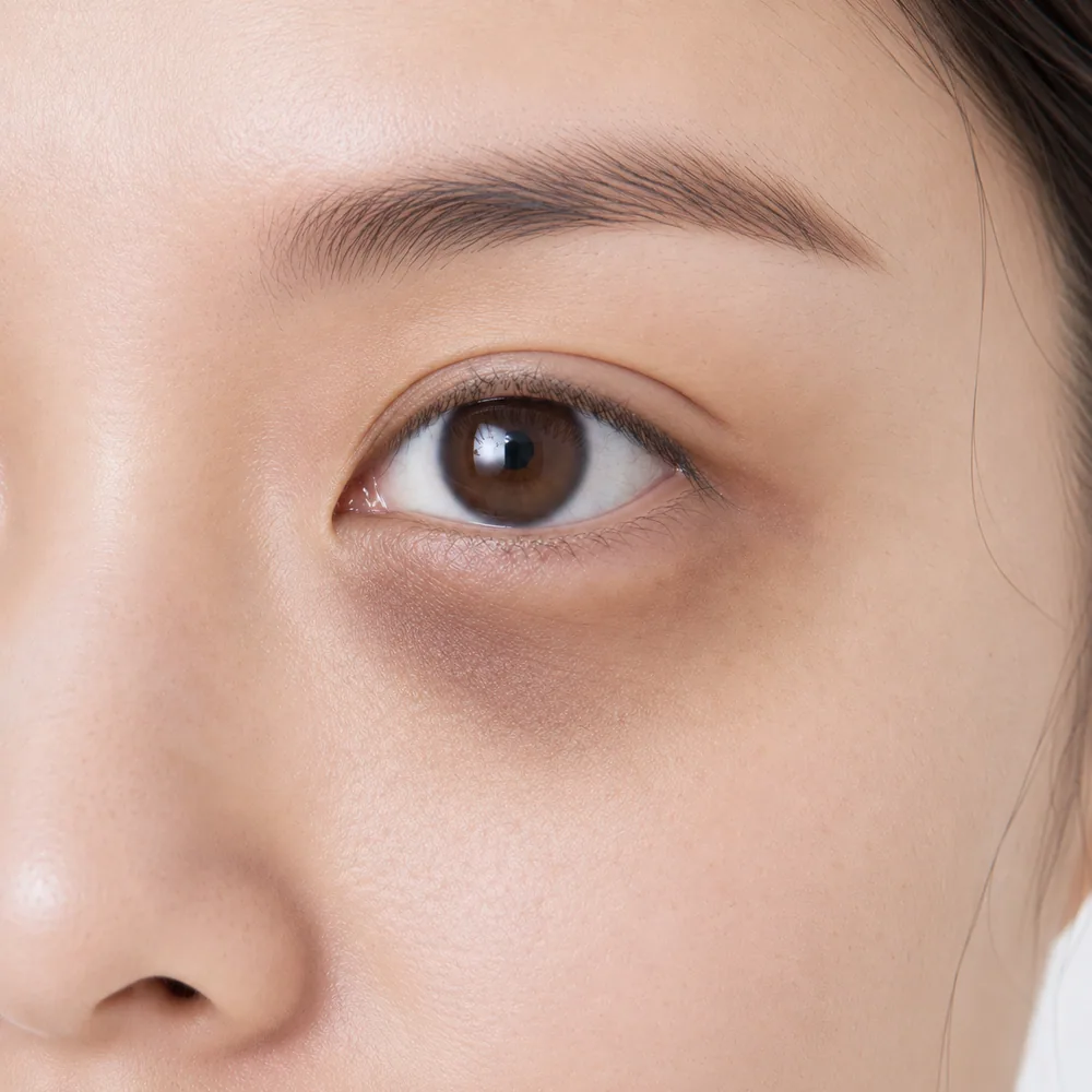 Vascular Dark Circles