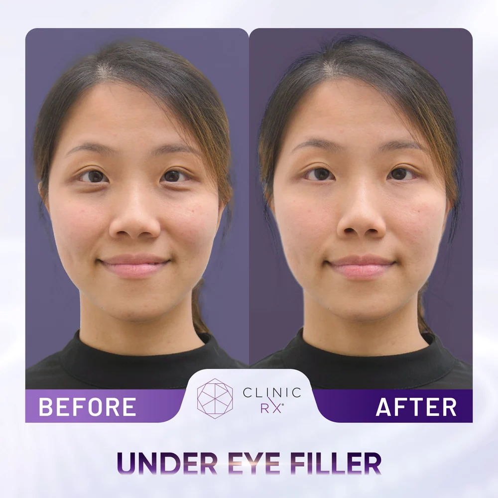 Eyebags result 1