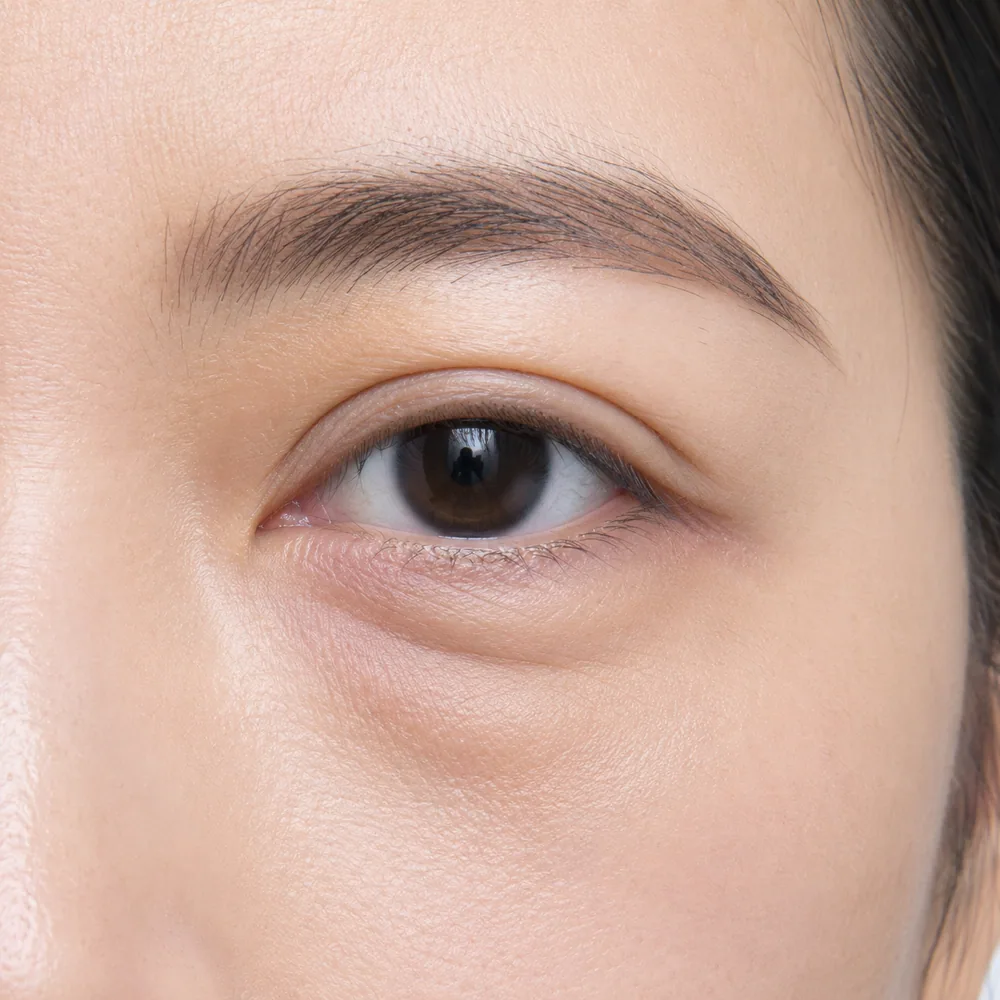 Skin-Related Eyebags