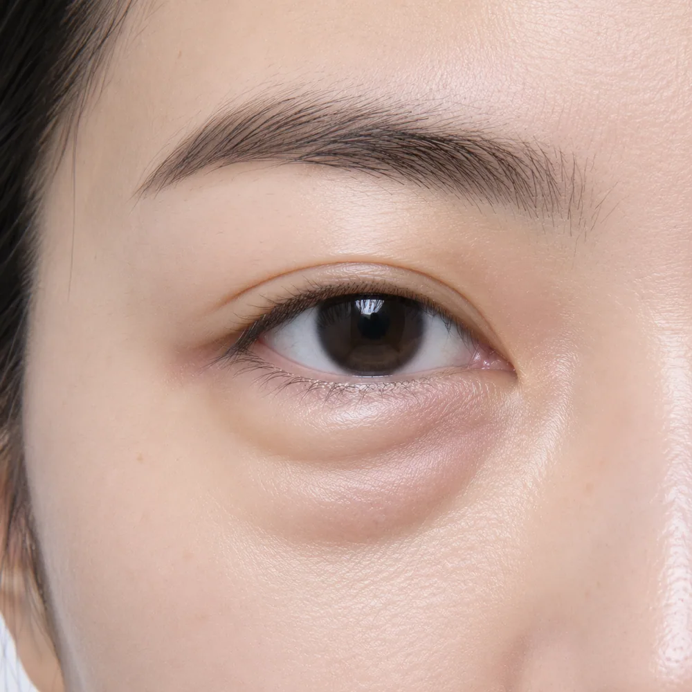 Fluid-Related Puffiness