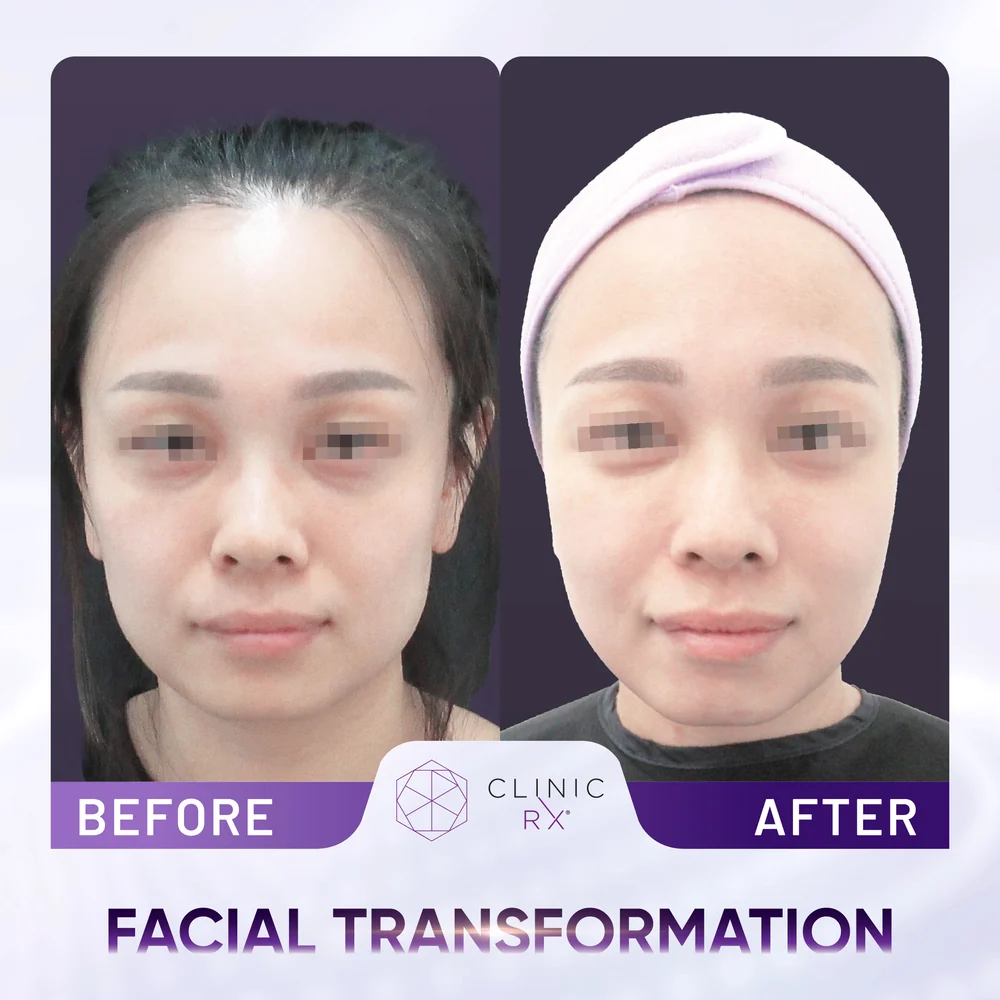 Facial Disharmony result 2