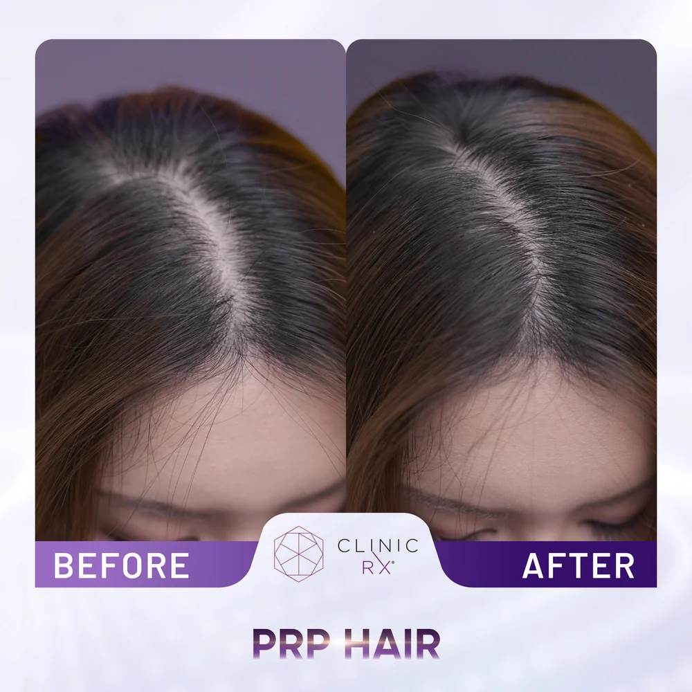 Hair Loss result 1