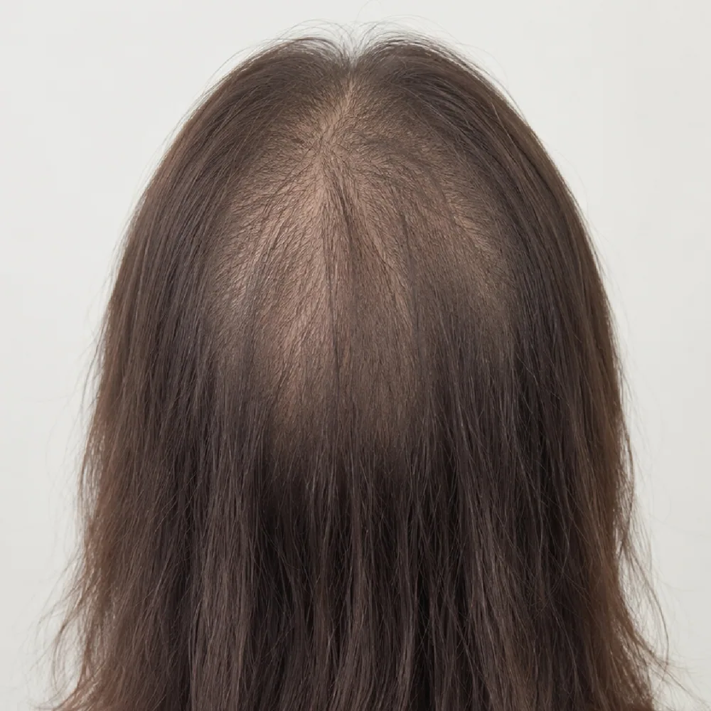 Alopecia Areata