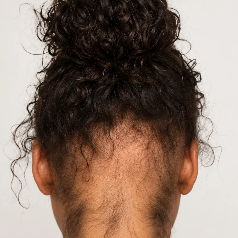 Traction Alopecia