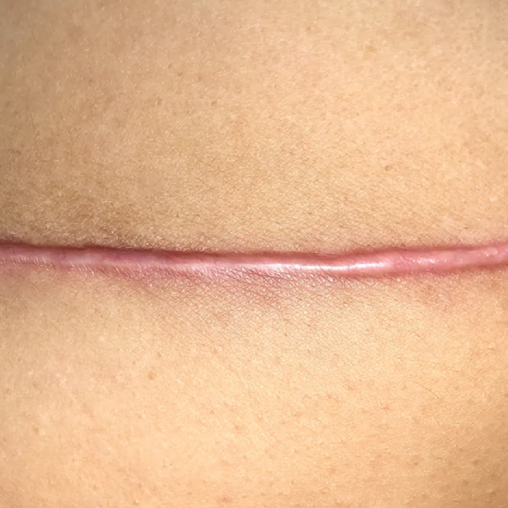 Keloid Scar
