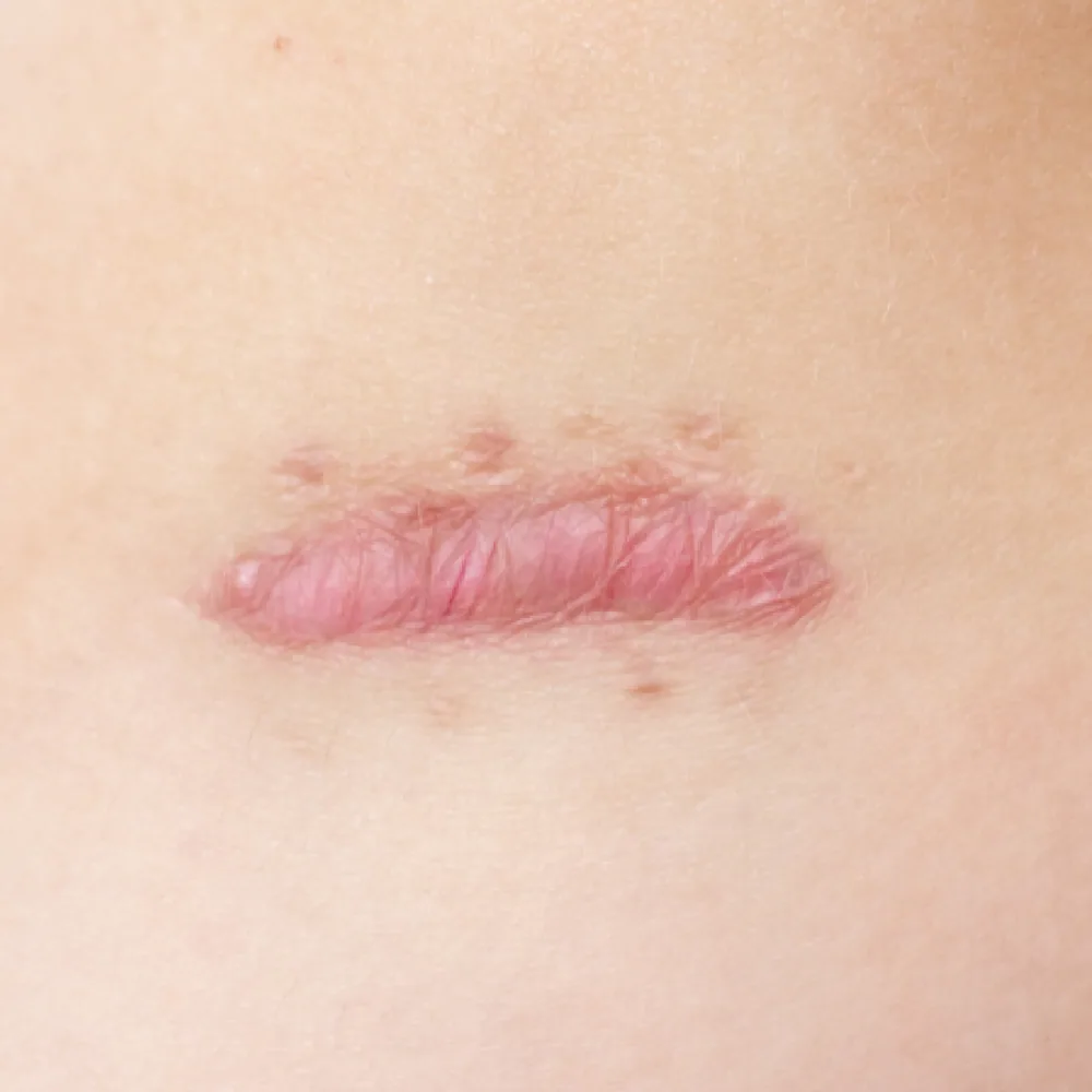 Hypertrophic Scar