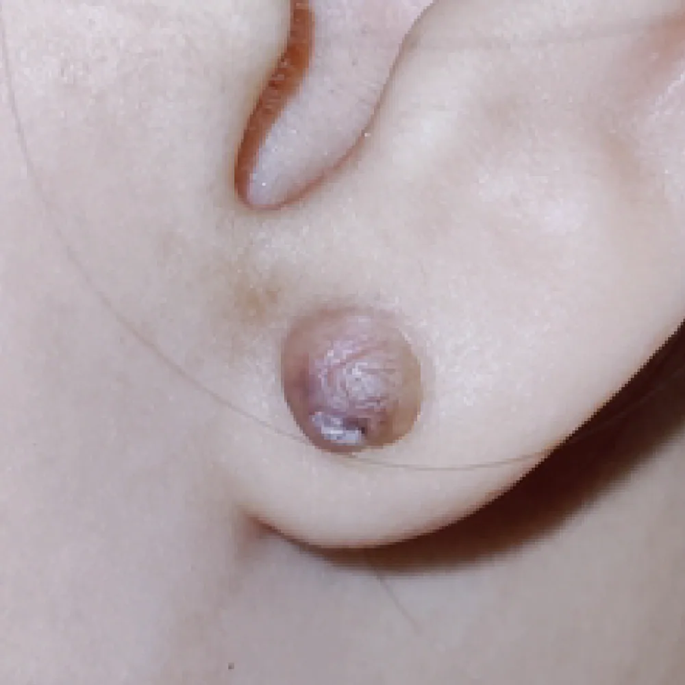 Recurrent Keloid