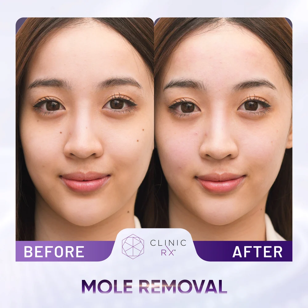 Mole result 1