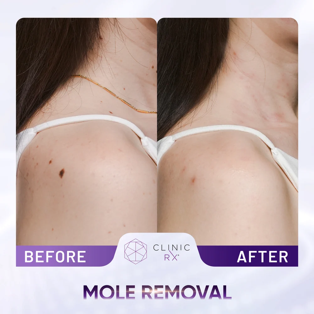 Mole result 2