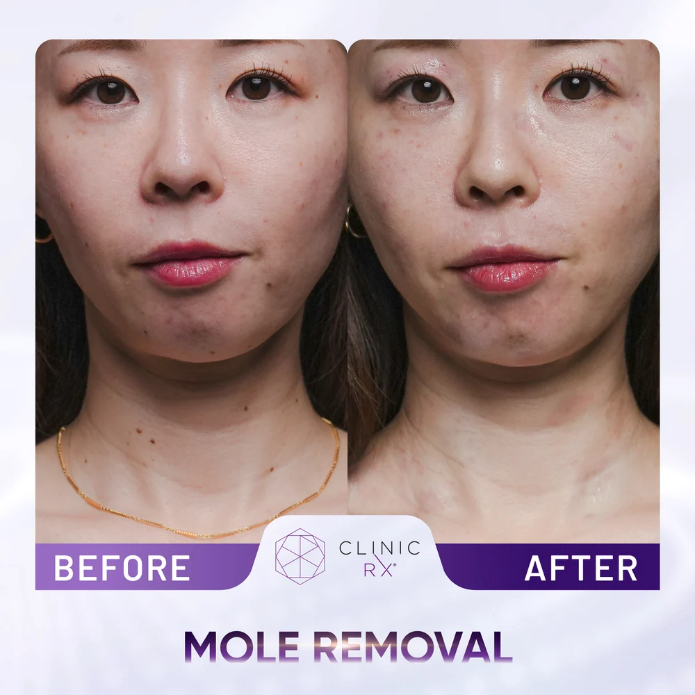Mole result 3