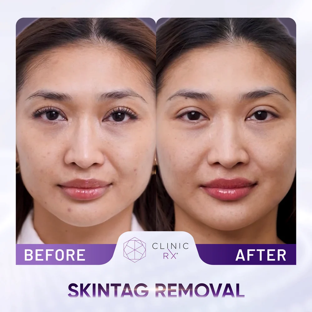 Mole result 4