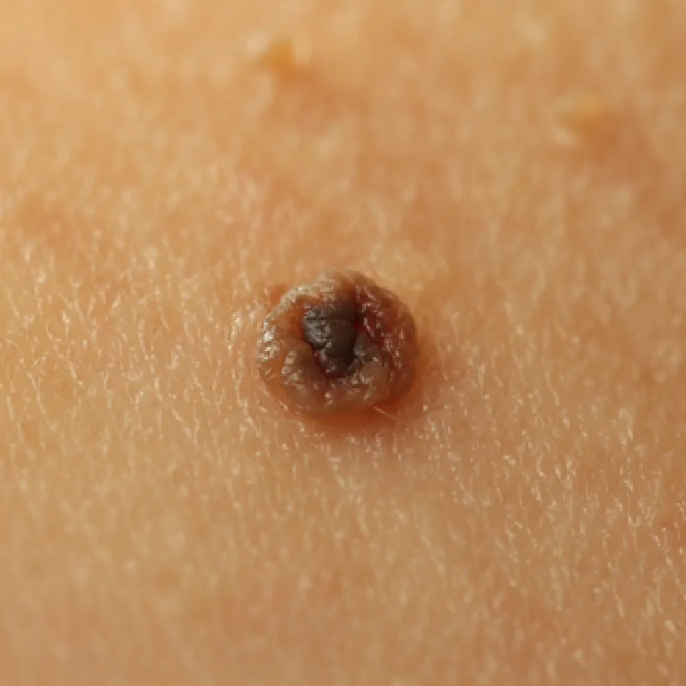 Flat Moles
