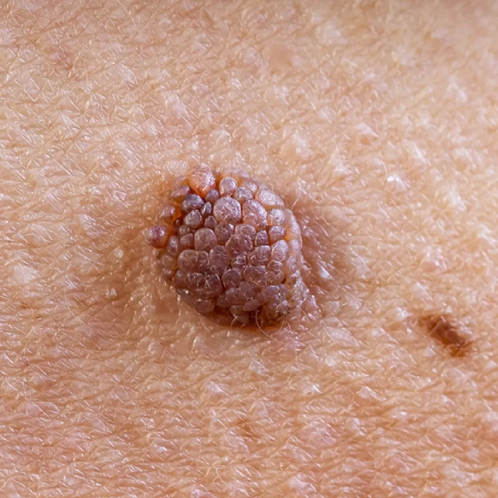 Raised Moles
