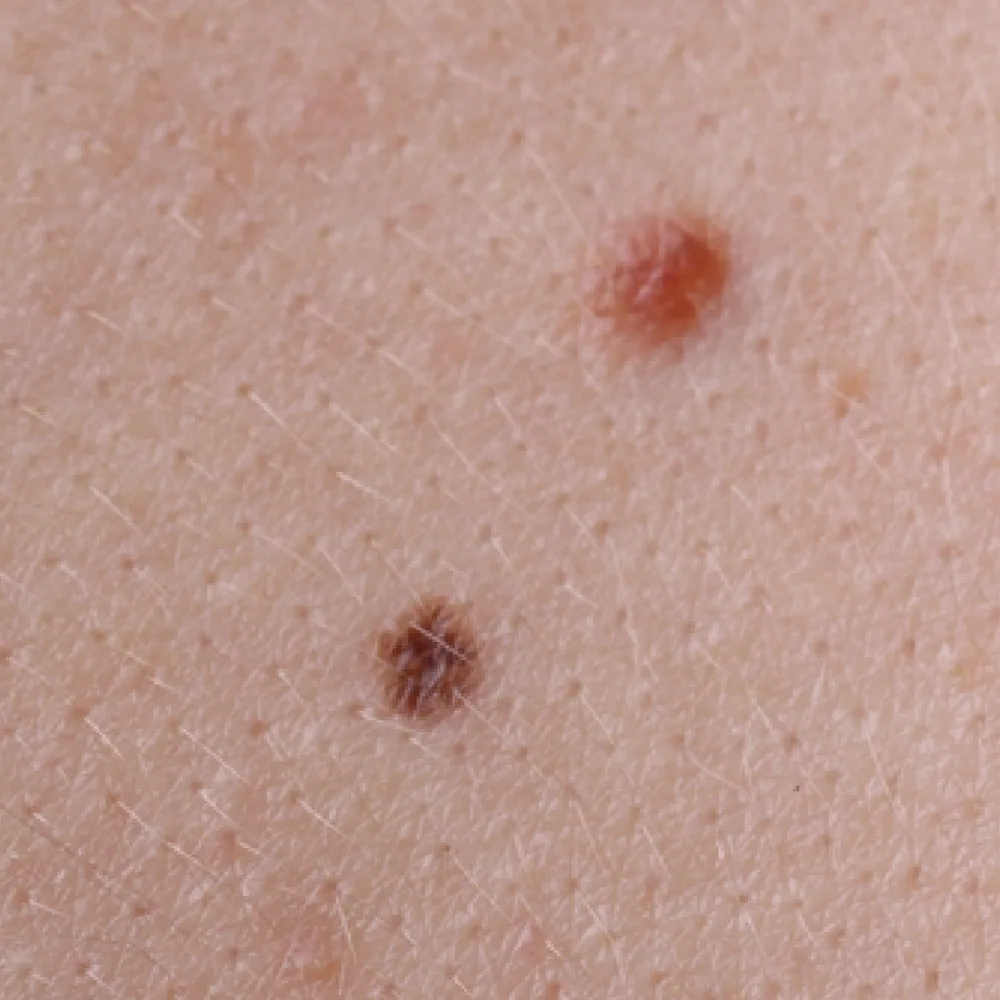 Congenital Moles