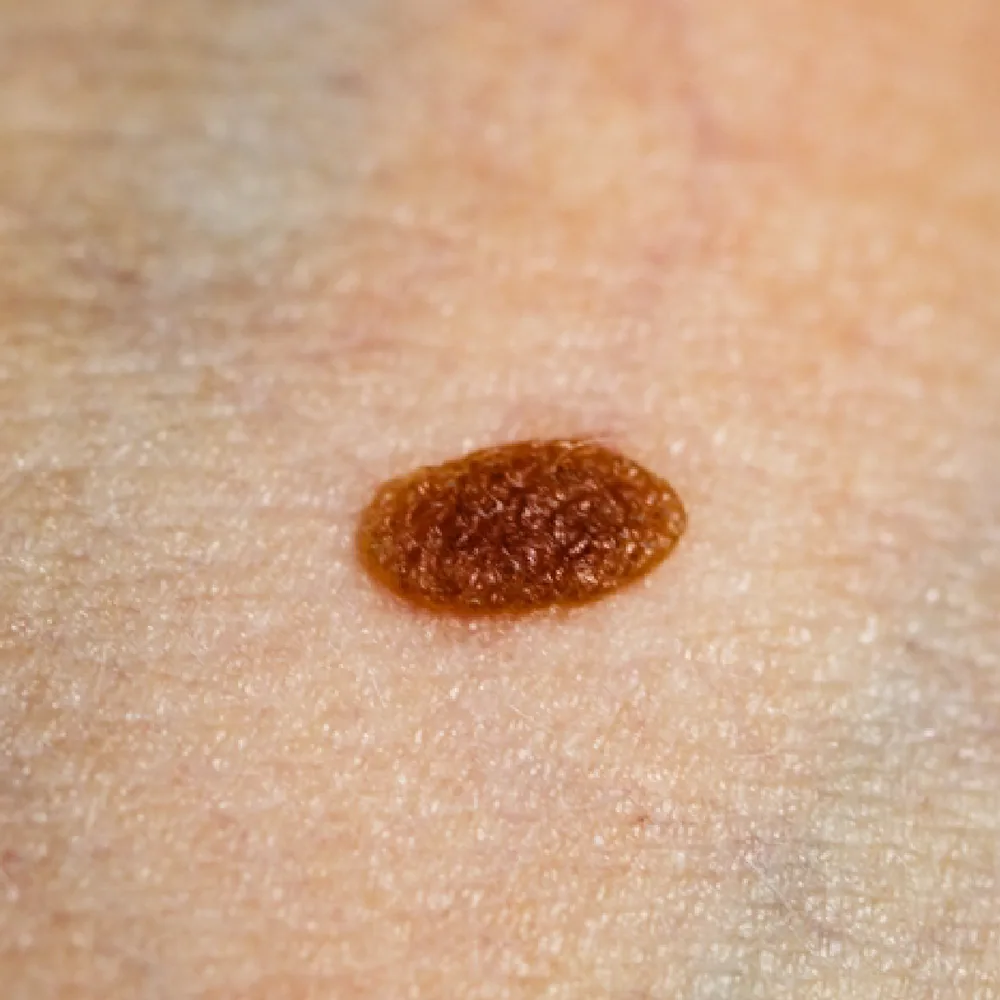 Acquired Moles