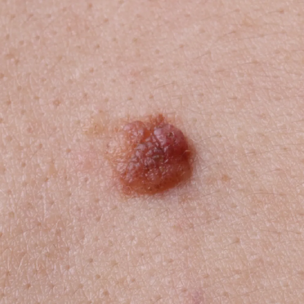 Atypical Moles