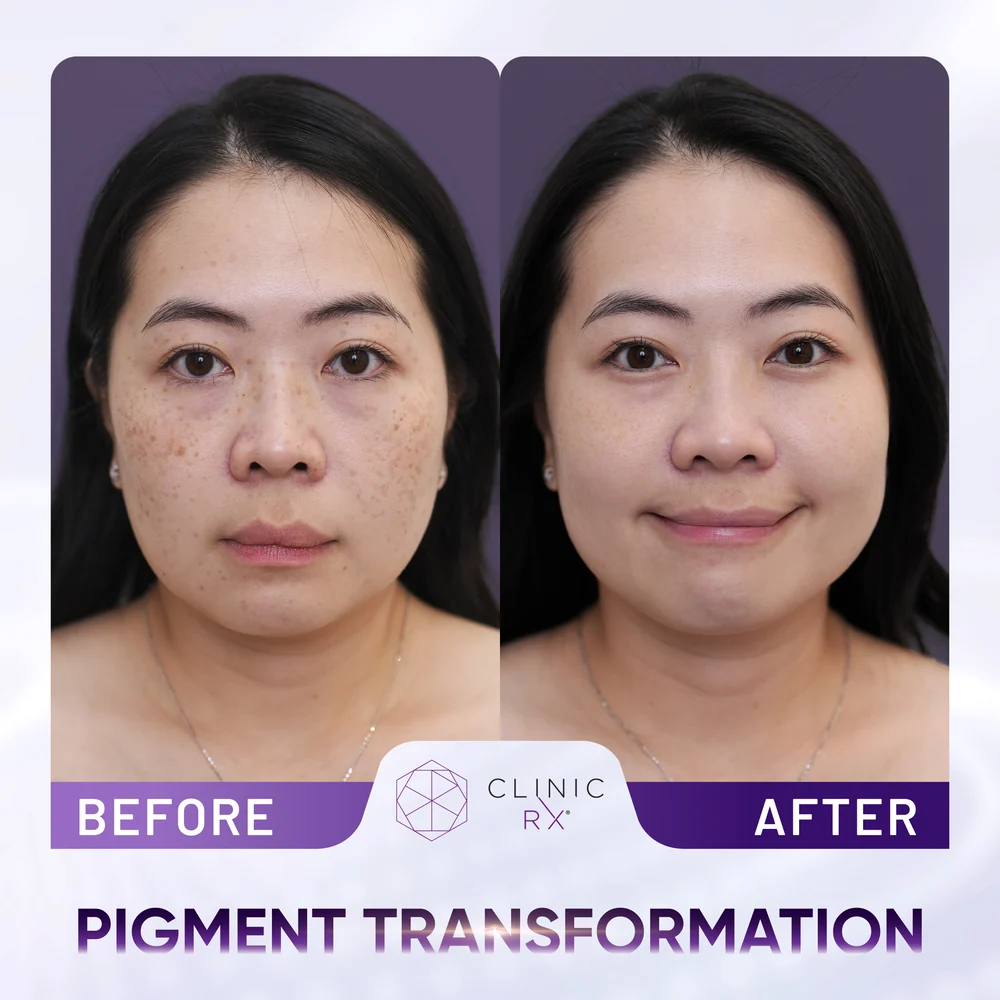Pigmentation result 1