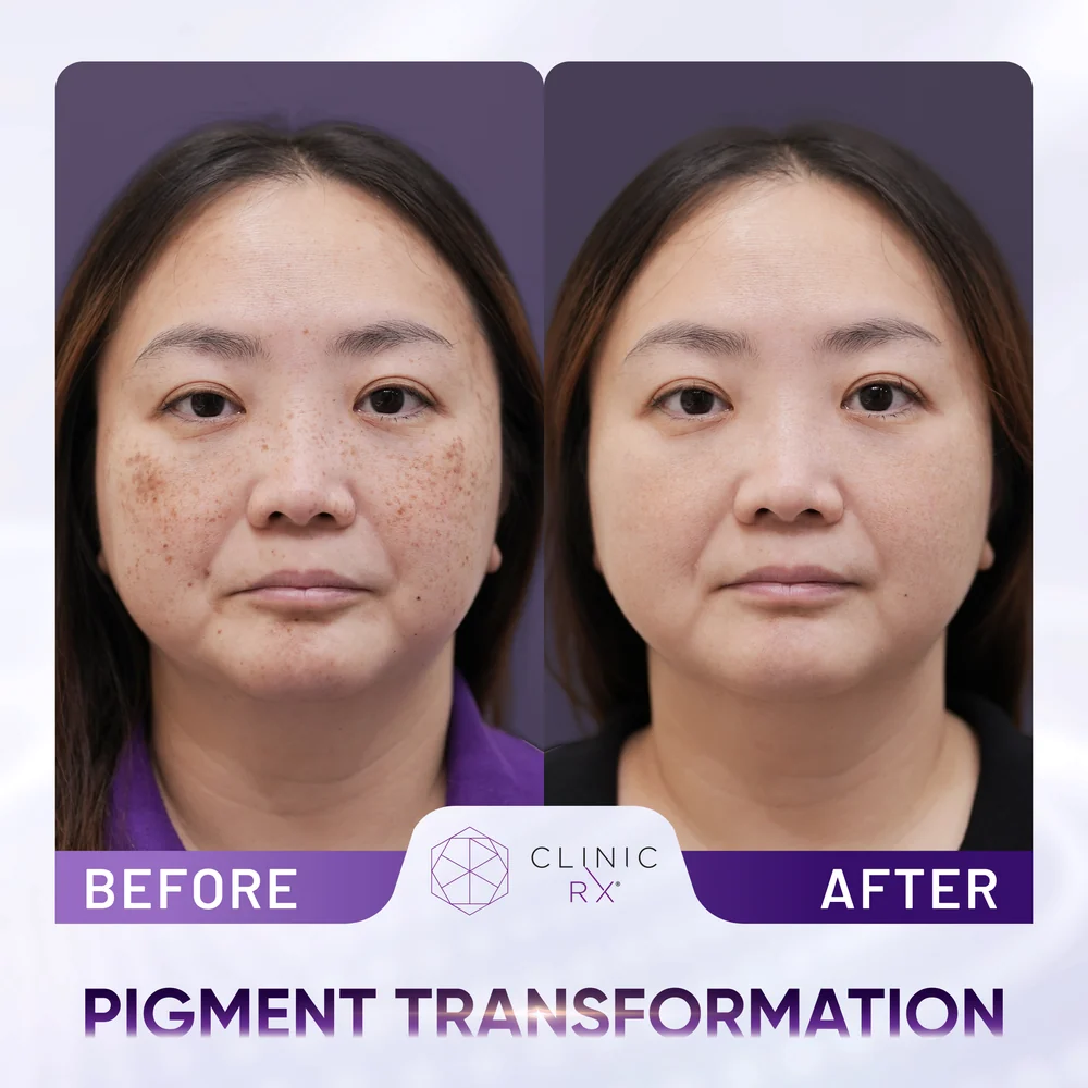 Pigmentation result 2