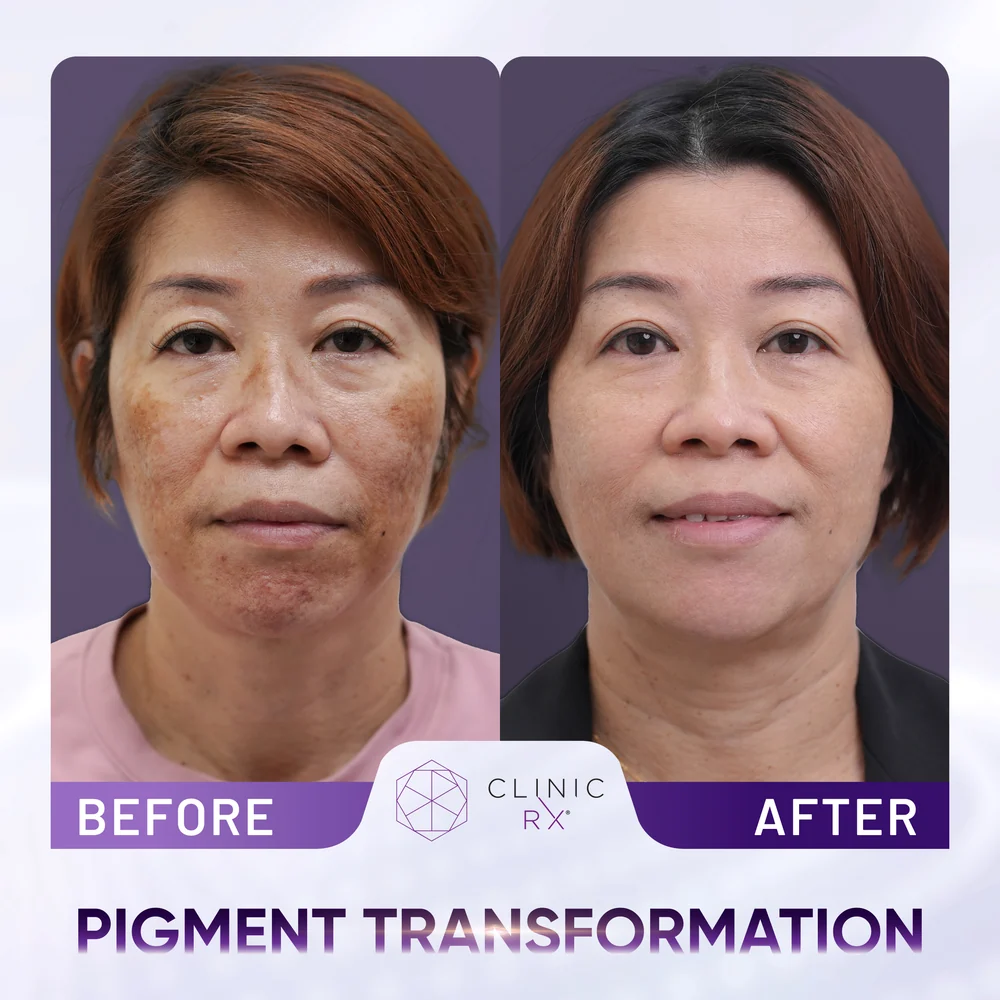 Pigmentation result 3