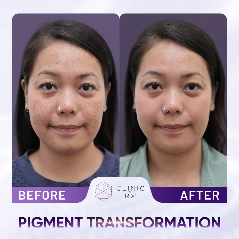 Pigmentation result 4