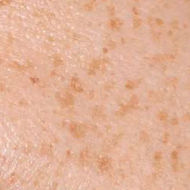 Freckles