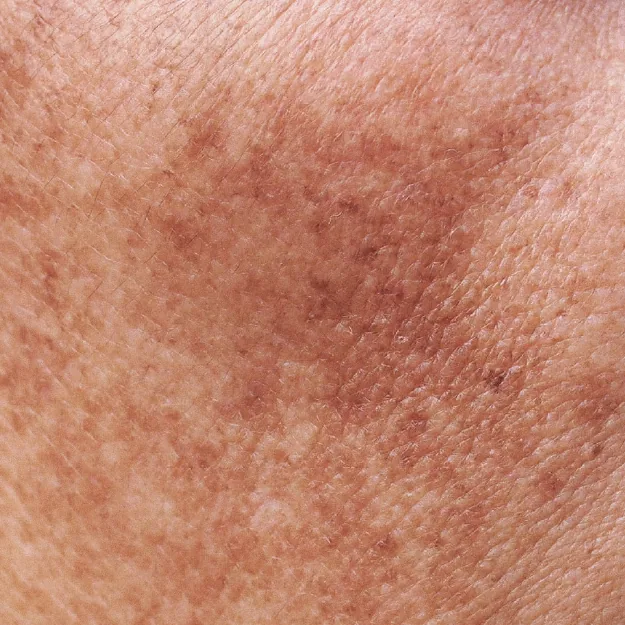Melasma