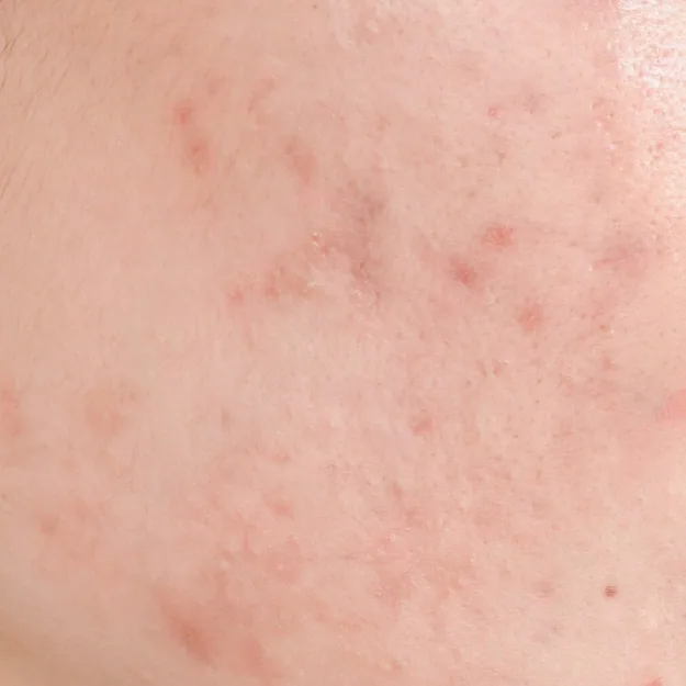 Post-Inflammatory Hyperpigmentation (PIH)