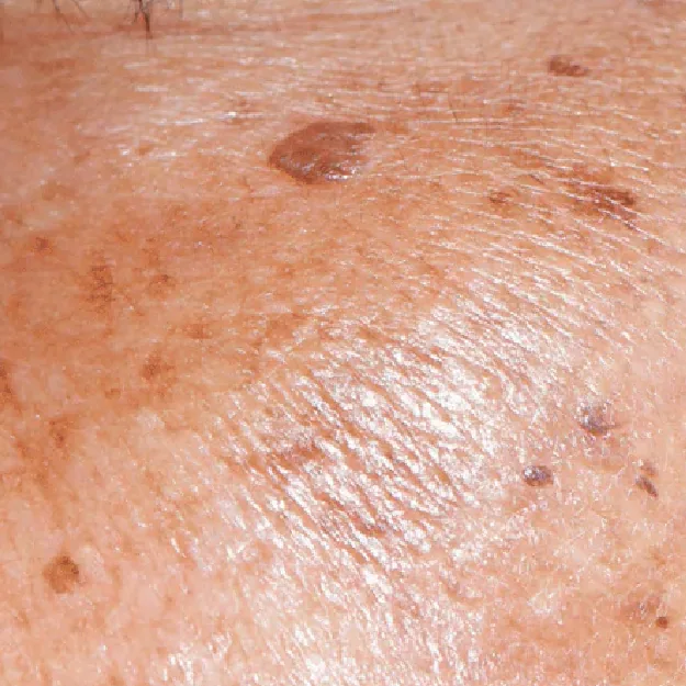 Sun & Age Spots