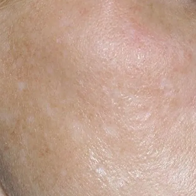 Uneven Skin Tone