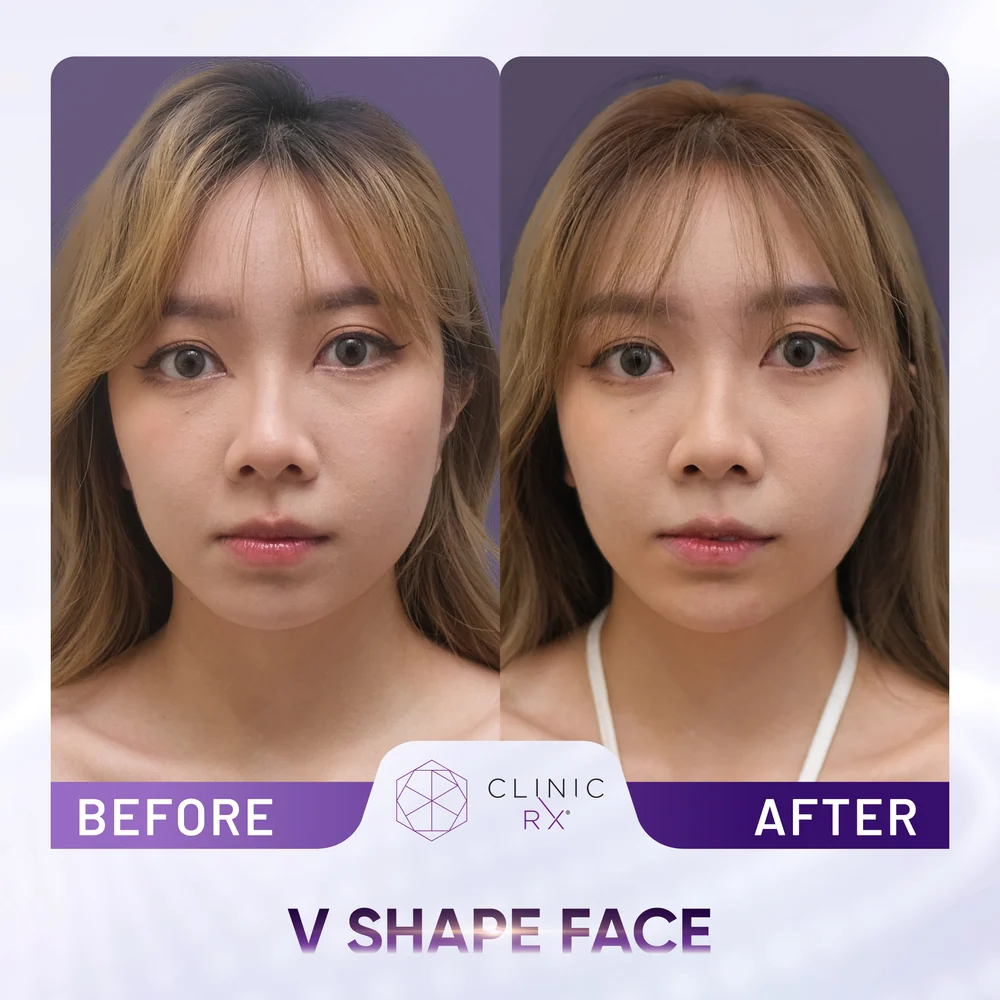 Square Jaw result 1