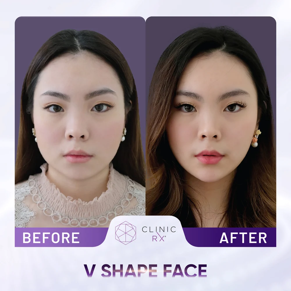 Square Jaw result 2