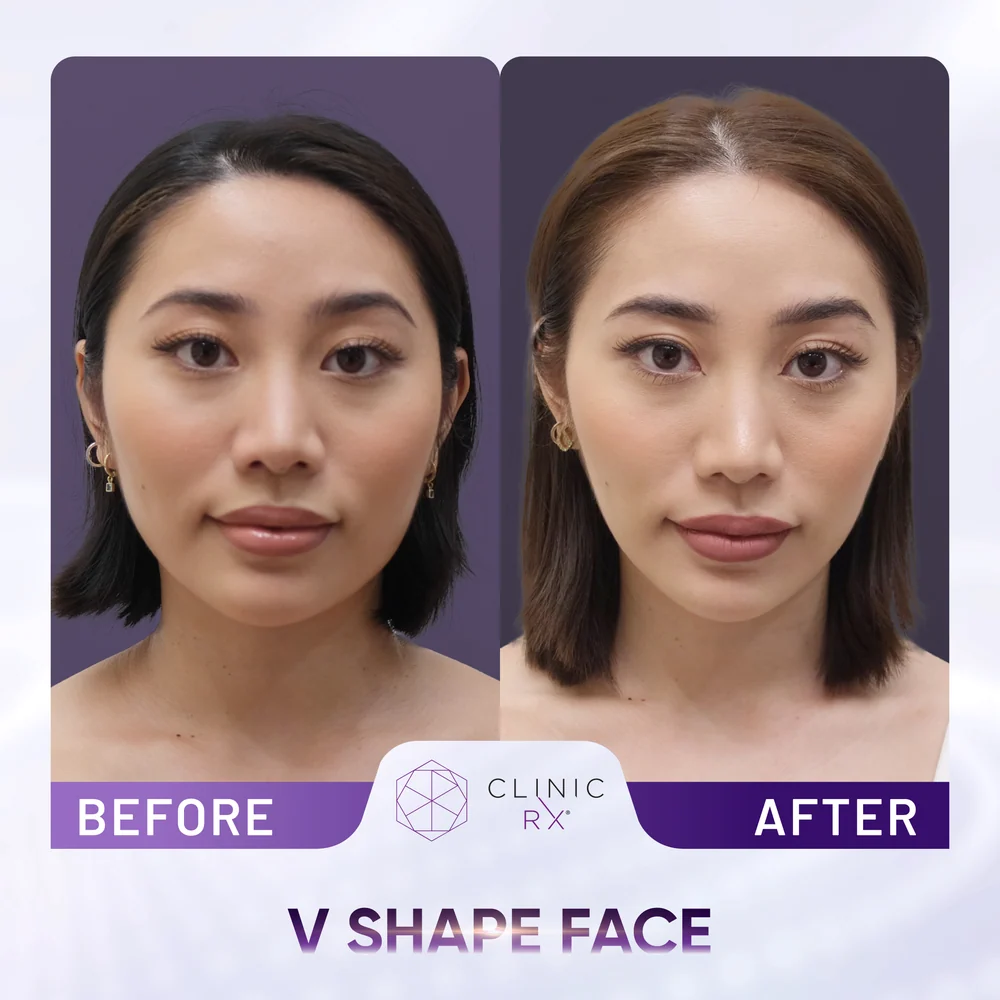 Square Jaw result 3