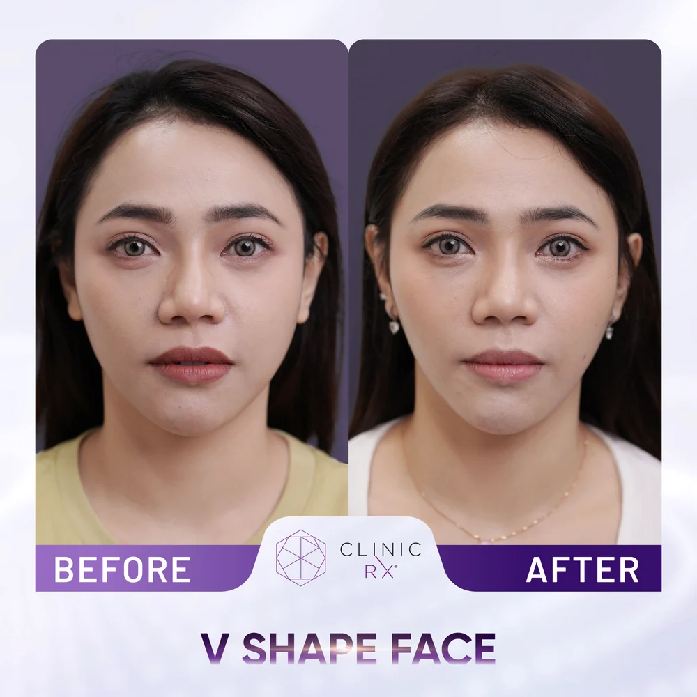 Square Jaw result 4