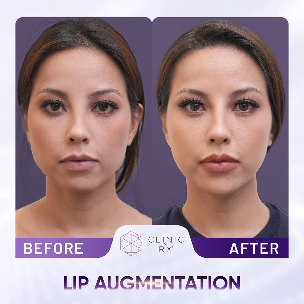 Thin Lips result 1