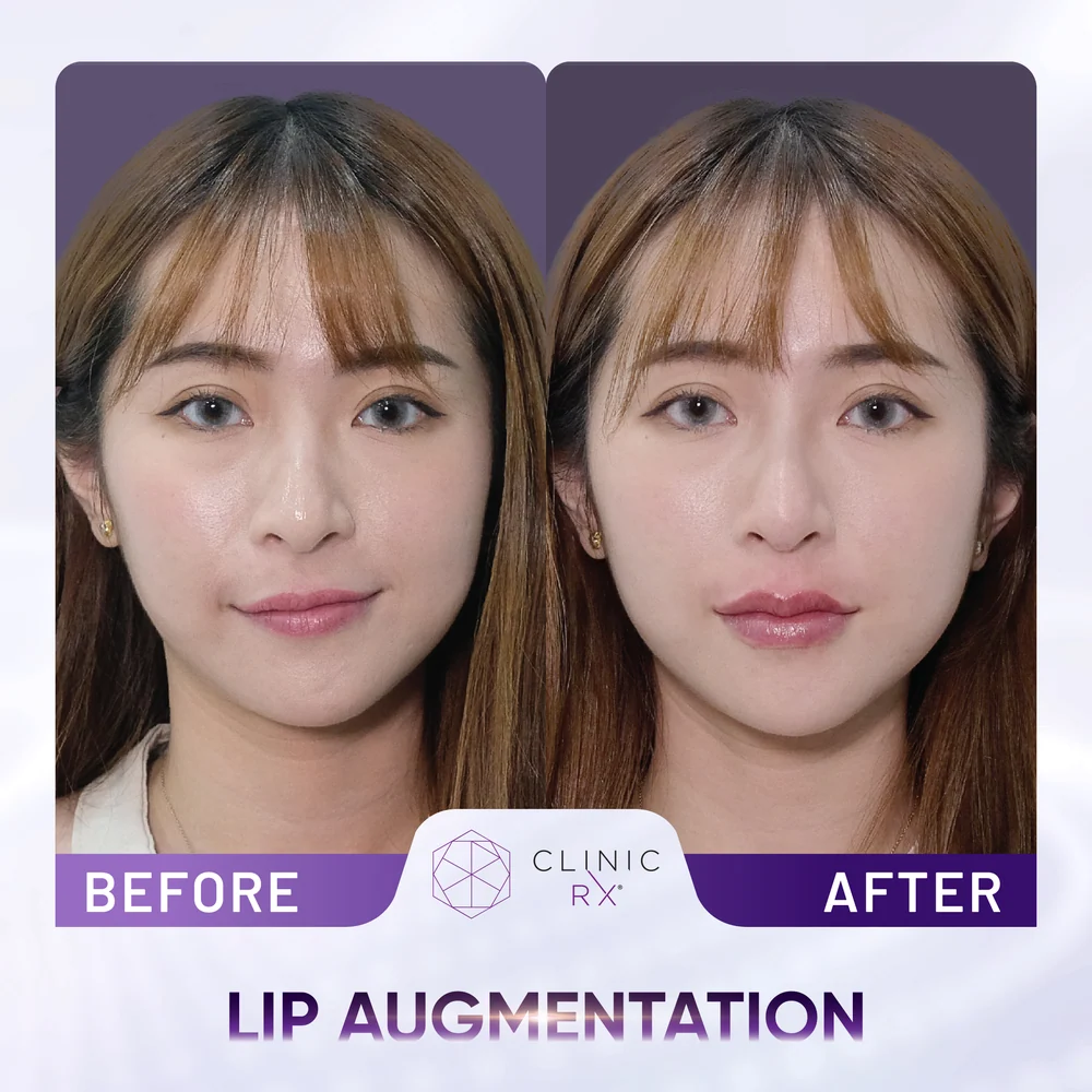 Thin Lips result 2